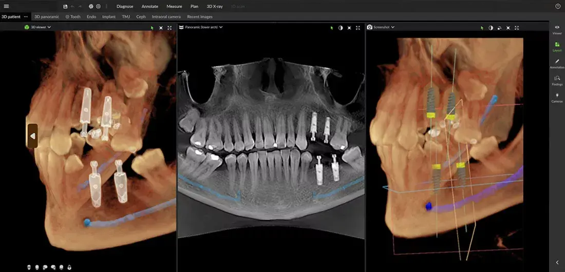 Implant.jpg (1)